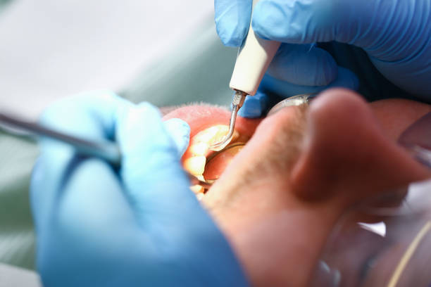 Best Emergency Wisdom Teeth Removal in Arnold Line, MS