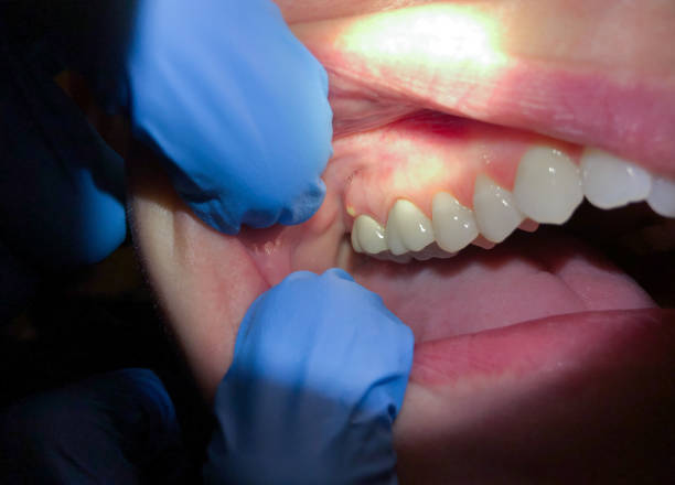 Best Emergency Dental Care for Broken or Chipped Teeth in Arnold Line, MS